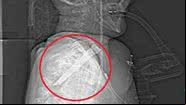 Homem fica com faça presa no garganta e sobrevive - Divulgação/Daily Mail